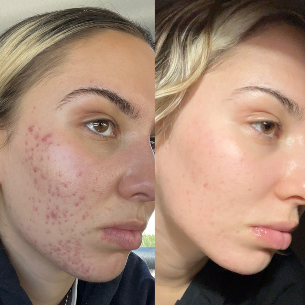girl with acne scarring